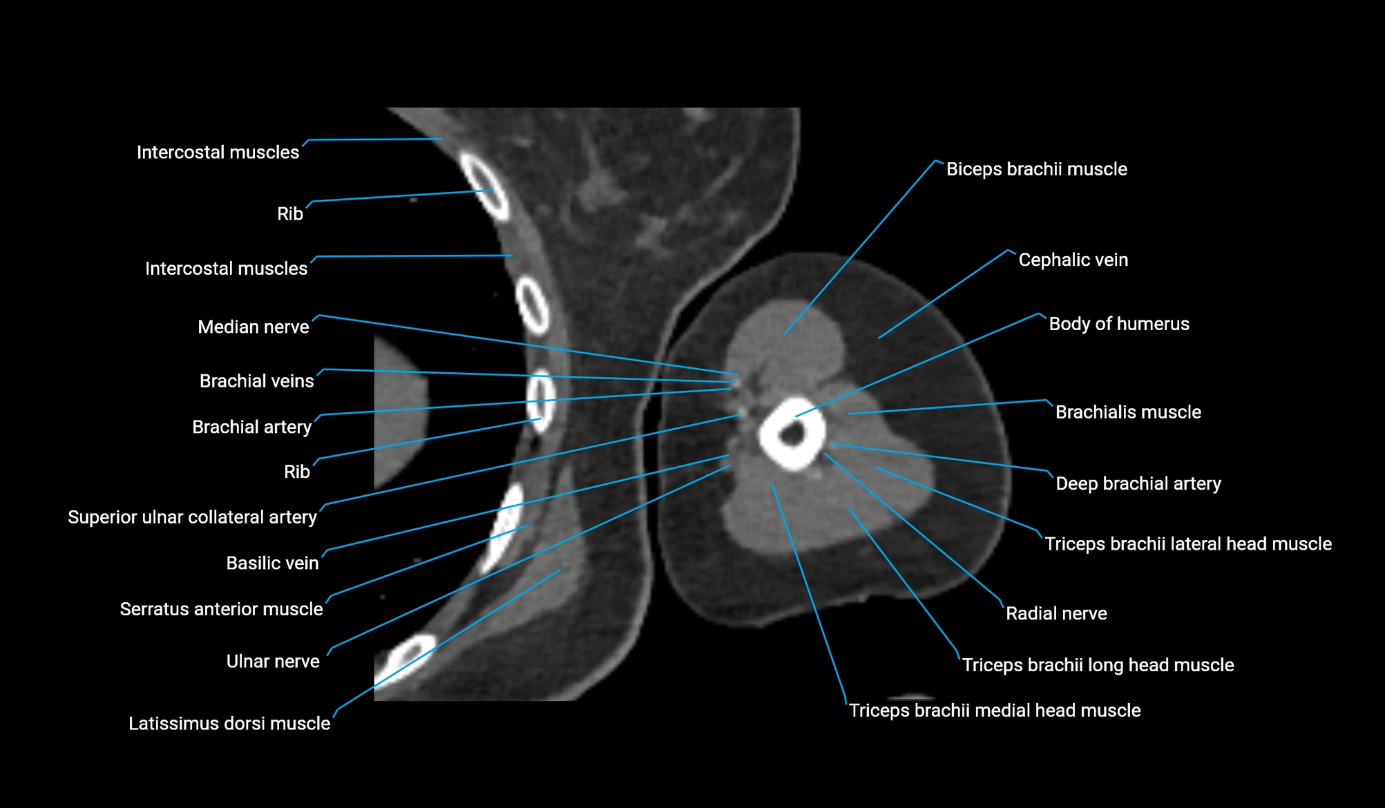CT upper arm axial  cross sectional anatomy labelled radiology image -00250.webp